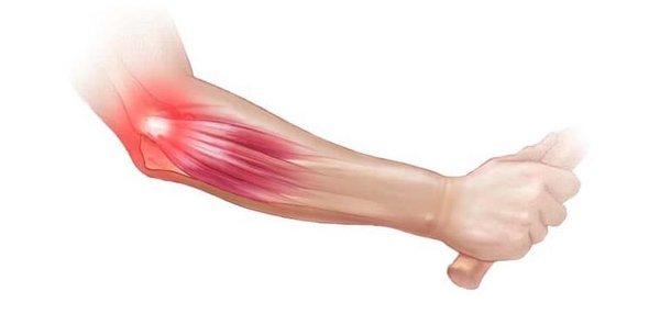 Tennis elbow