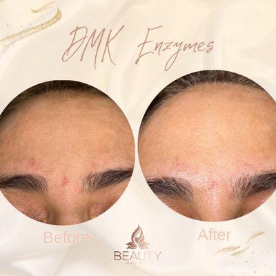 DMK enzymes therapy before & right after. It is great as a pre-event treatment