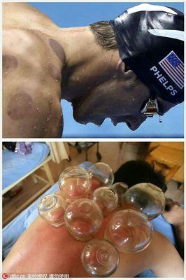 Cupping masage therapy helps with pain, inflammation and blood flow. $40 $30 minutes cupping therapy. $20 with a regular massage