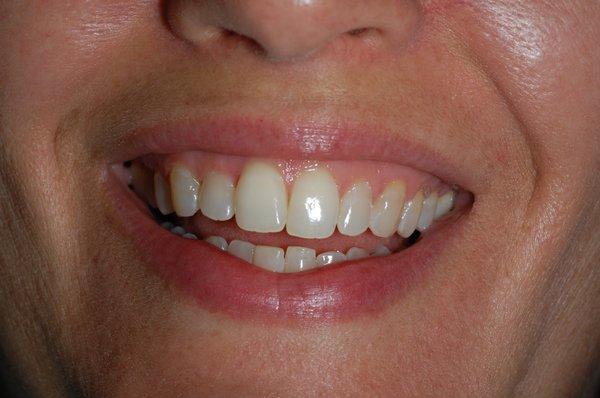 Before ZOOM! Whitening procedure.