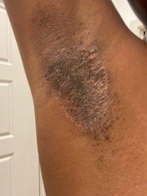 Results of underarm wax