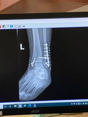 Left and fracture