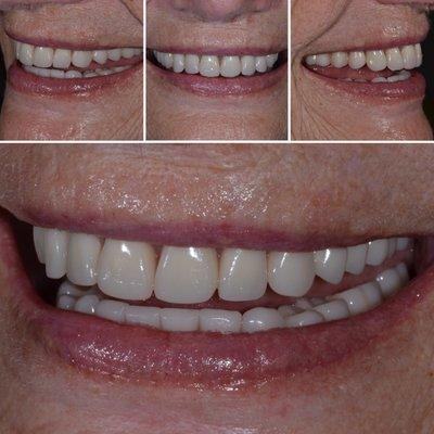 Dentures: Esthetic and Functional. Utilizing dental implants.