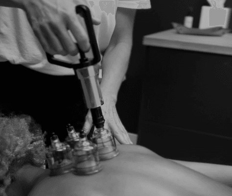 STATIONARY CUPPING THERAPY