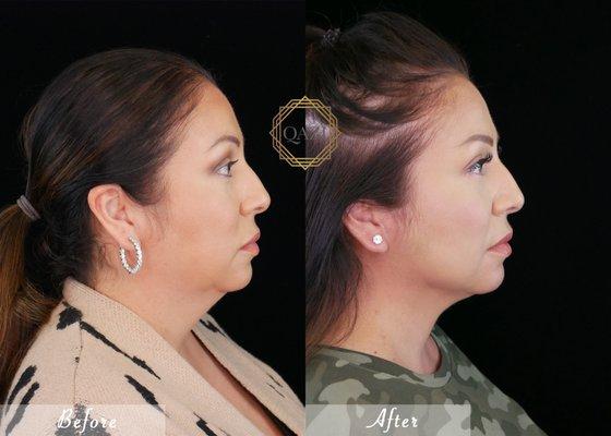 Neck MicroLipo Treatment Results