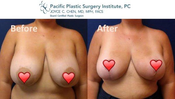 Lovely lady underwent breast reduction with over 500 g removed from each breast!  She loves her new look & her neck and back pain is gone!