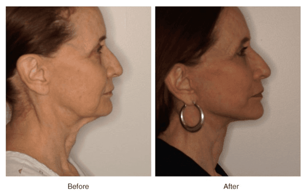 Vertical Vector Facelift with Corset Platysmaplasty