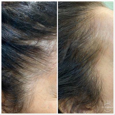 Try SMP-scalp micro pigmentation to add density to your sides .