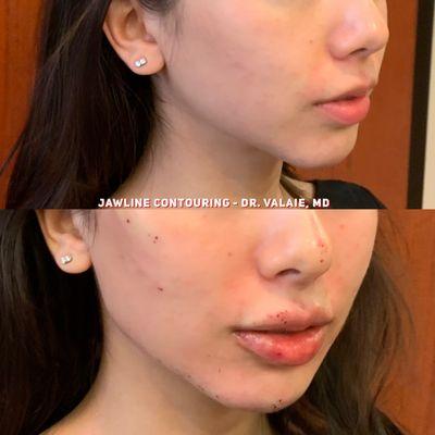 Jawline Contouring - Dr.Valaie, MD