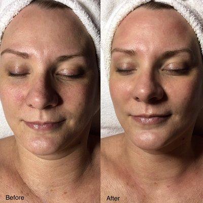 Rezenerate Facial before and after.