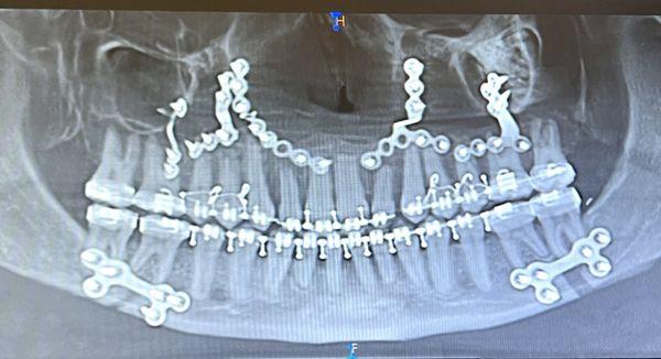 Jaw after surgery with plates and pins, teeth and braces, bones and gaps.