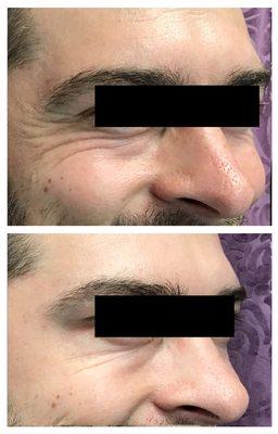 Crow's Feet on a young man almost disappear after Botox