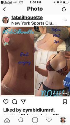 After Body Sculpting - We provide Post Op Lymphatic Massage, Treatments & Garments