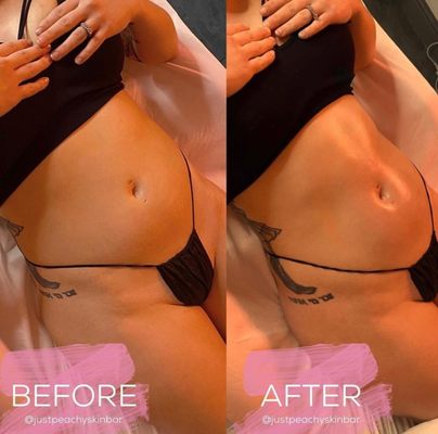 Body Sculpting using Ultrasonic Cavitation + RF and Wood Therapy