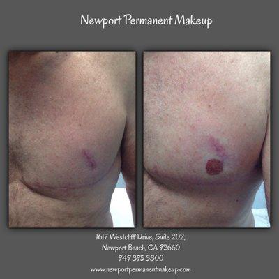 Natural looking male areola following a Gynecomastia procedure.