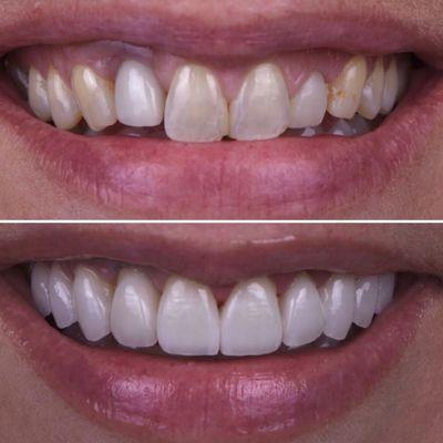 Smile enhancement with porcelain veneers. Case designed and executed by Dr. Tatevik Pilosyan.