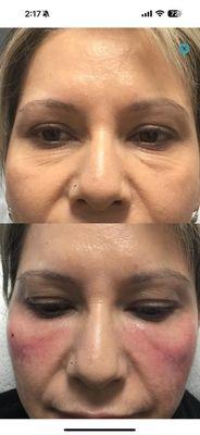 PRF treatment for under eyes