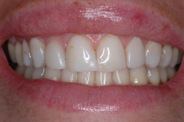 Patient wanted a whiter more attractive smile.