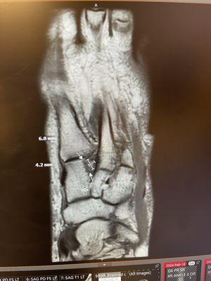 MRI of left foot