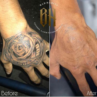 Before and after Laser Tattoo Removal