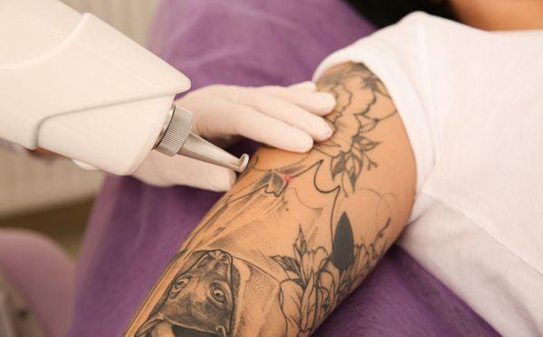 We pride ourselves to provide the best laser tattoo removal experience. Complimentary BLT numbing is always provided prior to treatment.