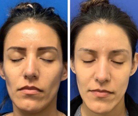 Sculptra Before After