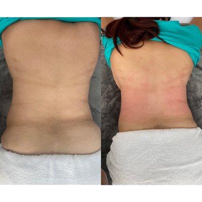 Cavitation Treatments