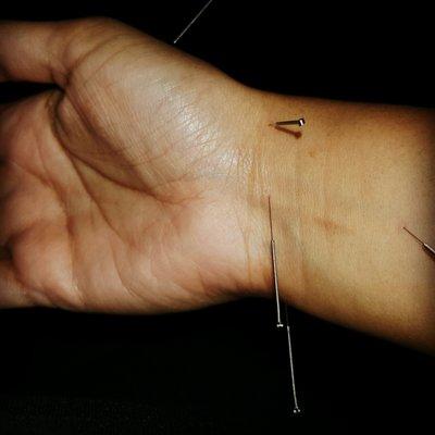 Acupuncture for stress