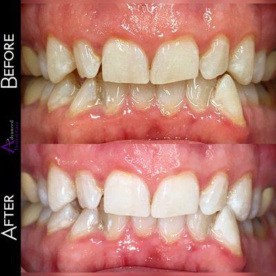 Before and after of Zoom! Teeth Whitening before Invisalign treatment and Porcelain Veneers - Cosmetic Dentist in Costa Mesa