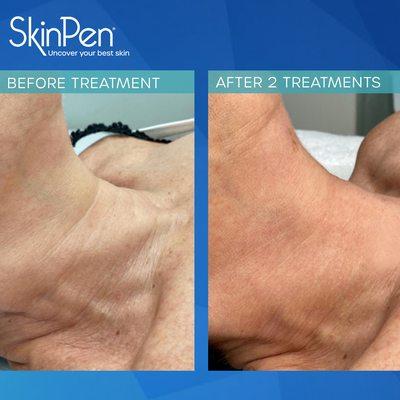 SkinPen for neck rejuvenation