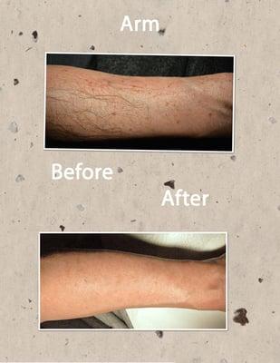 IPL photo rejuvenation for arm