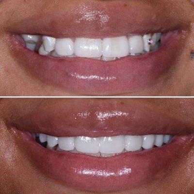 Revision of old veneers (top), The lower picture is her temporary veneers. Permanent veneers are placed 2 weeks later. Case by Dr. Pilosyan.