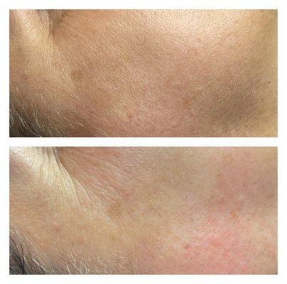 Before and after dermaplaning