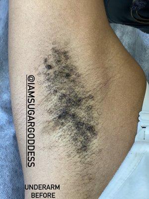 Before Underarm Sugaring