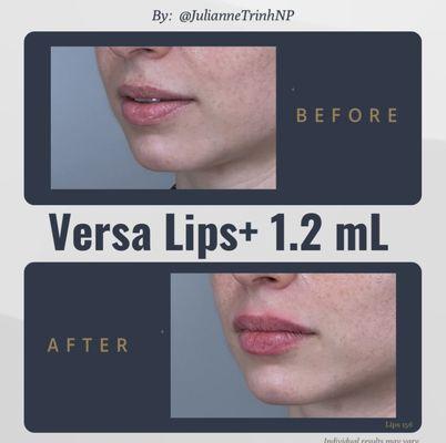 Lip Augmentation by Julianne Trinh NP using Versa Lips+