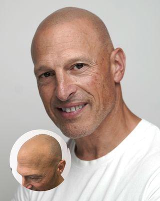 Scalp micro Pigmentation