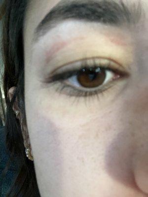 Left eyebrow burn