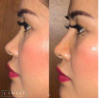 Liquid Rhinoplasty done by Dr. Jeffrey Sweat.