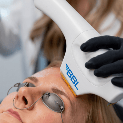 Coachlight offers BBL treatments by Sciton