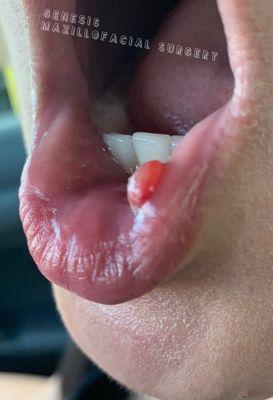 Patient with lip growth wanted to remove it.