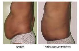 Before and after results of lipo laser treatments.