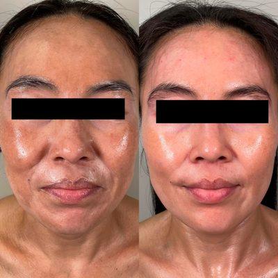 Melasma treatment