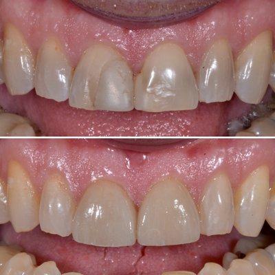 Veneers: Before & After