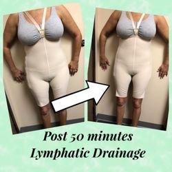 All of our therapists are specialized in the lymphatic system to properly apply the post-op technique's!