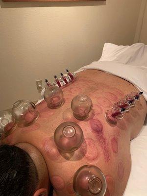 Stationary cupping and sliding cups to release pain from musculature