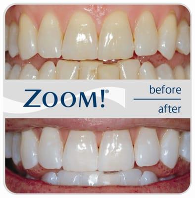 Zoom! Teeth Whitening