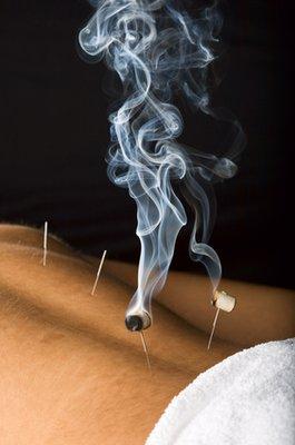 Moxabustion Therapy with acupuncture