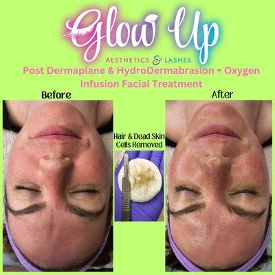 Before and After Dermaplane plus Hydrodermabrasion + Oxygen Infusion Facial Treatment.