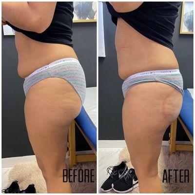 1st session booty lift and 45 mins laser lipo