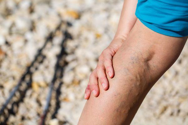 Varicose or Spider Veins....we can help you get healthy legs again!